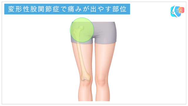 変形性股関節症で痛みが出やすい部位を示したイラスト。鼠径部(足の付け根)を中心とした股関節周囲を示している。