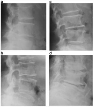 変形性腰椎症の重症度別レントゲン画像。骨棘形成や椎間板高の低下が進行する様子