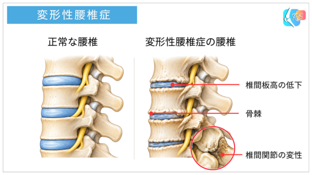 変形性腰椎症にみられる椎間板高の低下、骨棘、椎間関節の変性を正常な腰椎と比較したイラスト