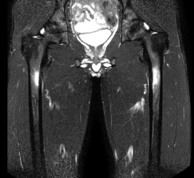 大腿骨疲労骨折のMRI画像|大腿骨骨幹部にみられる骨髄内の高信号変化