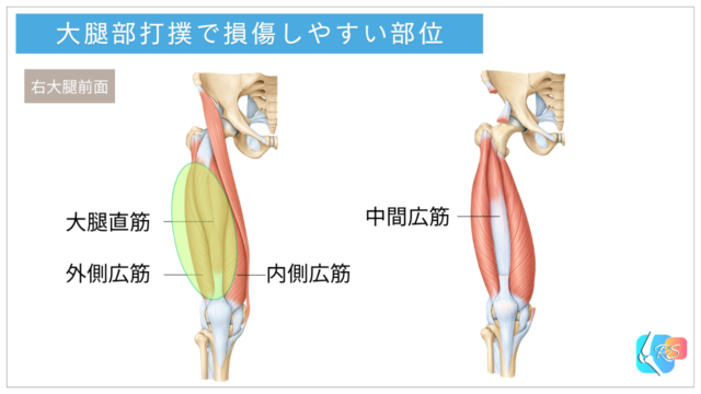 大腿部打撲で損傷しやすい大腿四頭筋の解剖図。右大腿前面の大腿直筋、外側広筋、内側広筋、中間広筋を示し、代表的な打撲部位を緑色で強調。