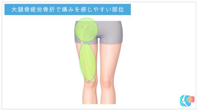 大腿骨疲労骨折で痛みを感じやすい部位|鼠径部・股関節周囲と太もも