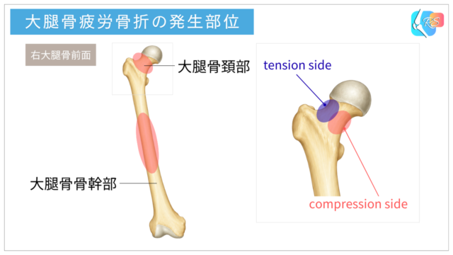大腿骨疲労骨折の発生部位|大腿骨頚部・骨幹部とtension side・compression side