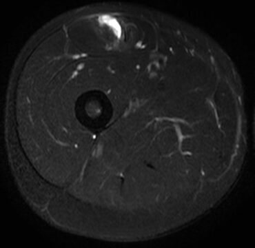 大腿部MRI横断像。大腿直筋周囲に高信号域を認める肉ばなれの画像。