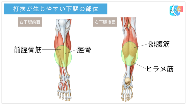 下腿部打撲で痛みが起こりやすい部位を示した下腿の前面・後面の解剖イラスト。脛骨、前脛骨筋、腓腹筋、ヒラメ筋の位置を示している。