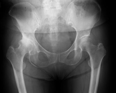 変形性股関節症の骨盤正面レントゲン画像。片側の股関節に関節裂隙の狭小化、骨棘形成、軟骨下骨の硬化がみられる。