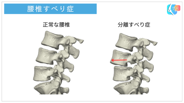 正常な腰椎と分離すべり症を比較したイラスト。分離すべり症では腰椎の一部が前方へずれている状態を示しています。