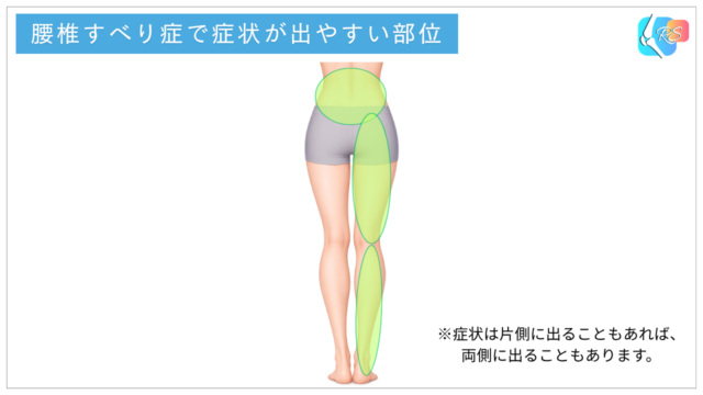 腰椎すべり症で症状が出やすい部位を示したイラスト。腰部から臀部、大腿後面、下腿にかけて痛みやしびれが出る可能性を示しています。