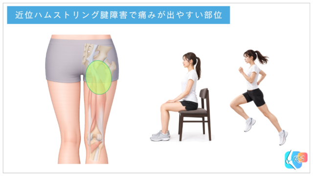 近位ハムストリング腱障害(PHT)で痛みが出やすい坐骨結節周囲と太ももの裏の付け根を示したイラスト。長時間の座位やランニングで痛みが生じる場面も紹介。